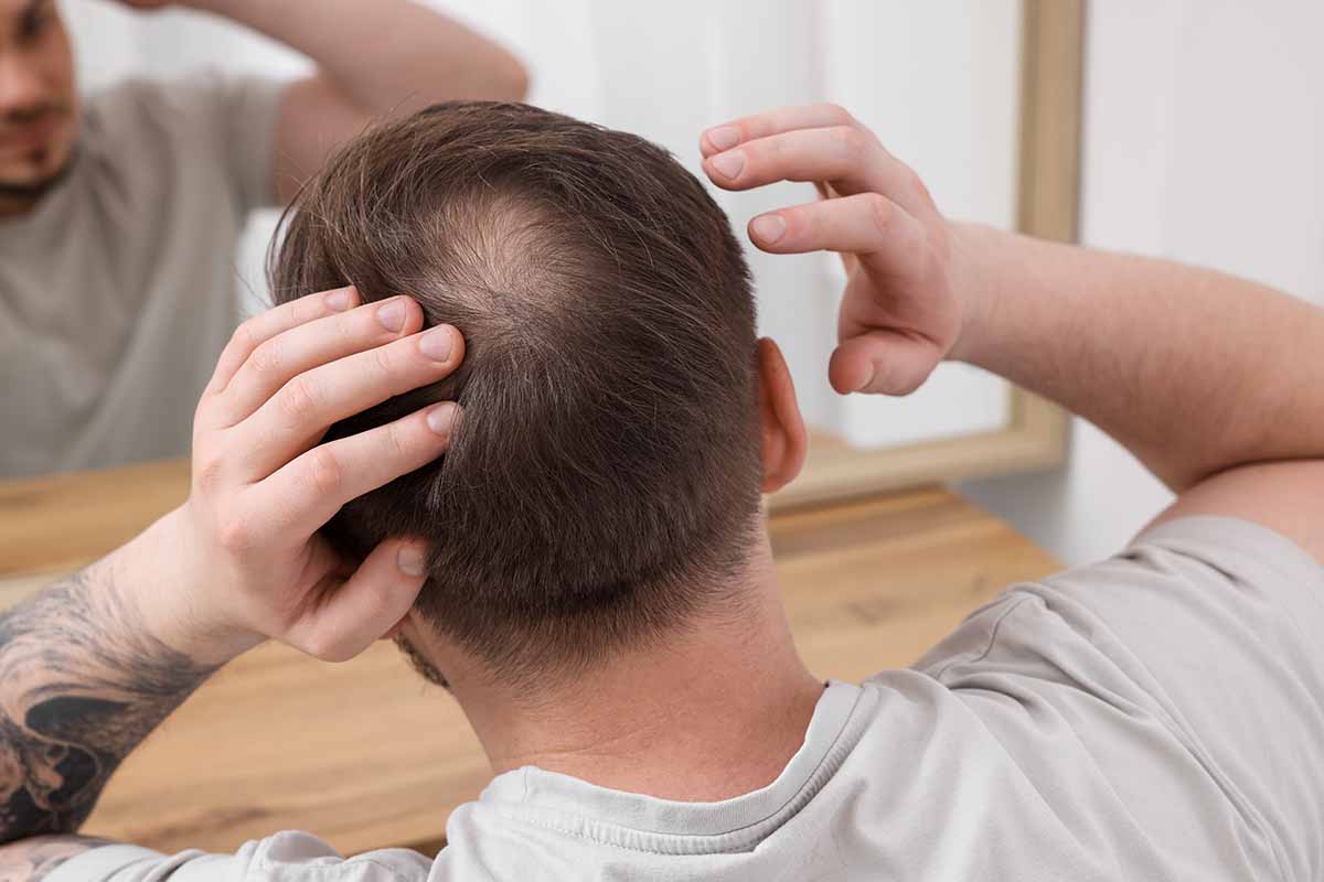 hair loss in men